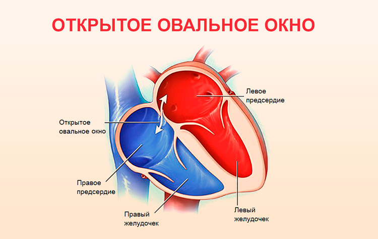 Открытое овальное окно в сердце у ребенка: симптомы, причины и лечение