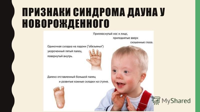 Синдром дауна у детей: симптомы, причины, лечение