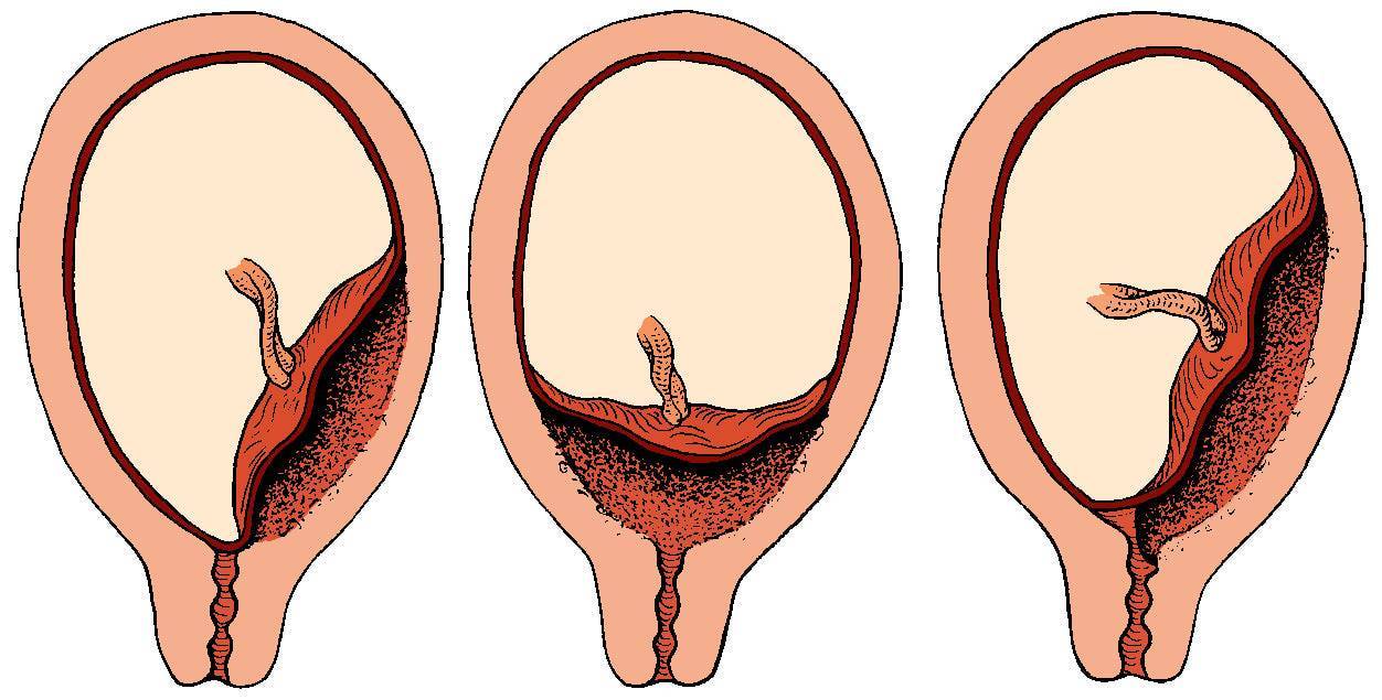 Плацента по задней стенке: что значит краевое предлежание по задней стенке матки, особенности расположения и прогнозы