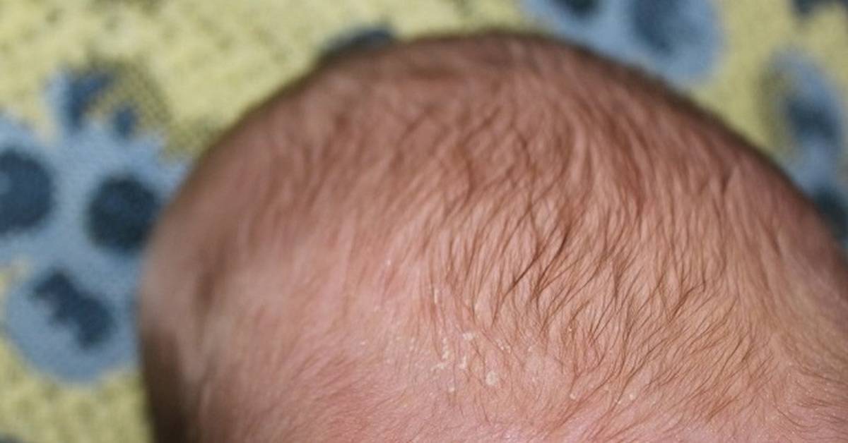 Почему происходит выпадение волос у ребенка?