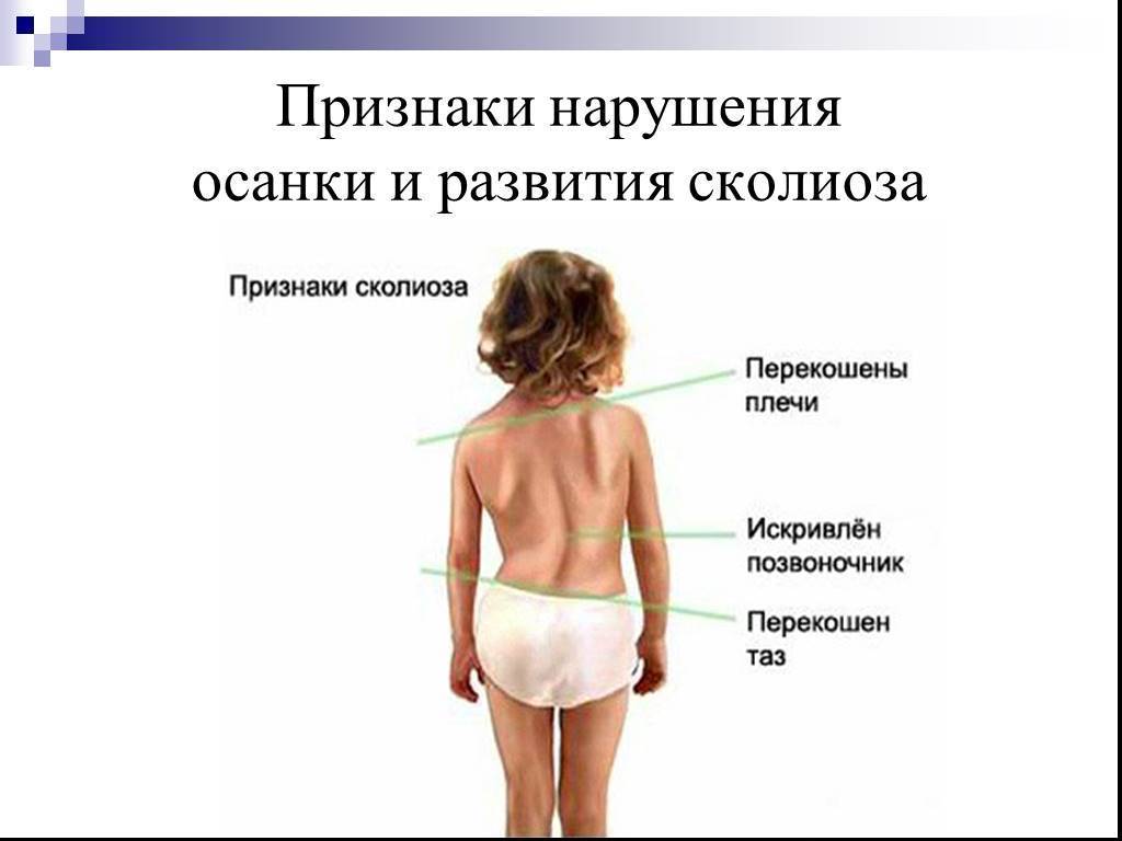 Основные меры профилактики сколиоза у детей