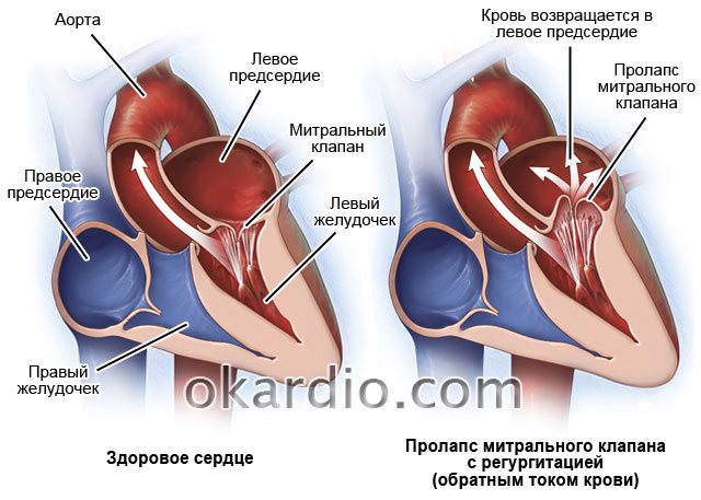 Пролапс митрального клапана у детей. малые аномалии развития сердца