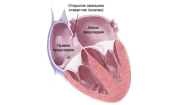 Овальное окно в сердце новорожденного: что это такое, когда должно закрыться у грудничка