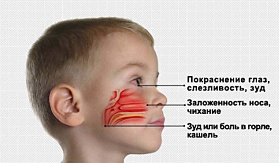 Причины заложенности носа без соплей у детей и методы лечения