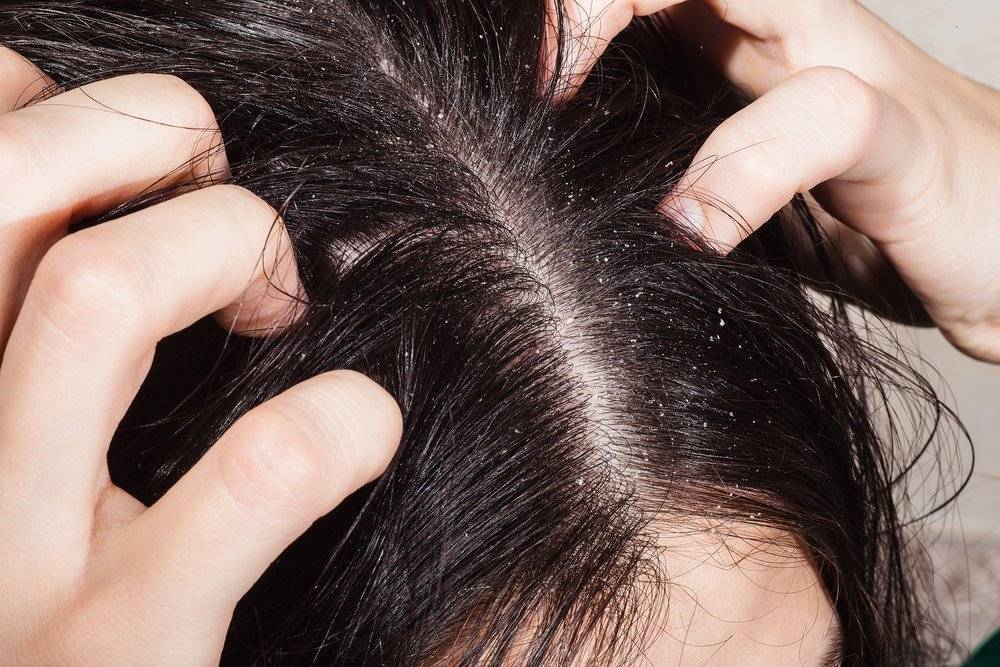 Шелушение кожи головы и выпадение волос у детей | обзор лучших средств от выпадения волос