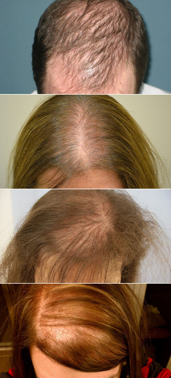 У ребенка выпадают волосы: причины и лечение