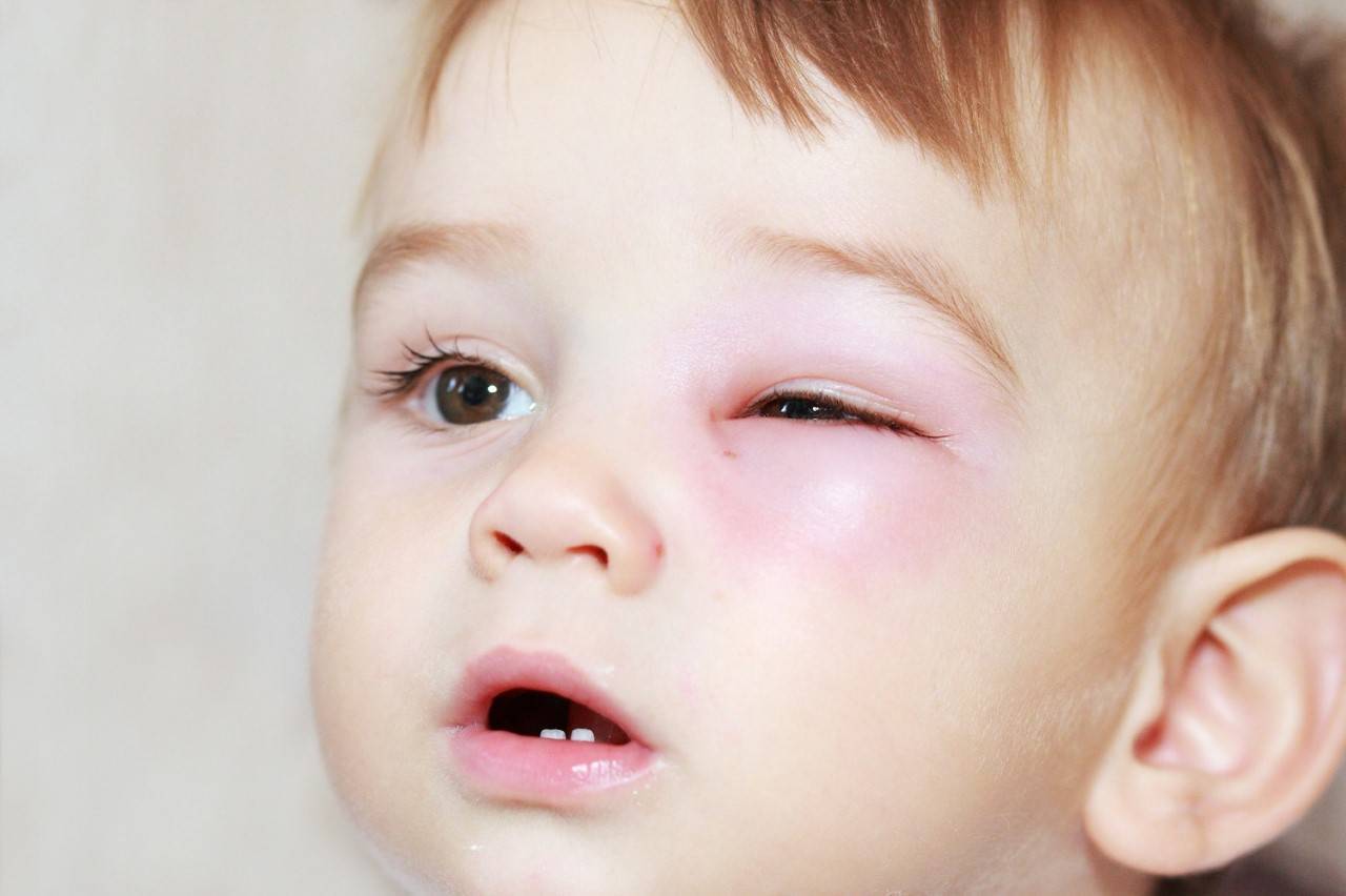 Опух глаз у ребенка: причины, лечение, что делать нельзя - "здоровое око"