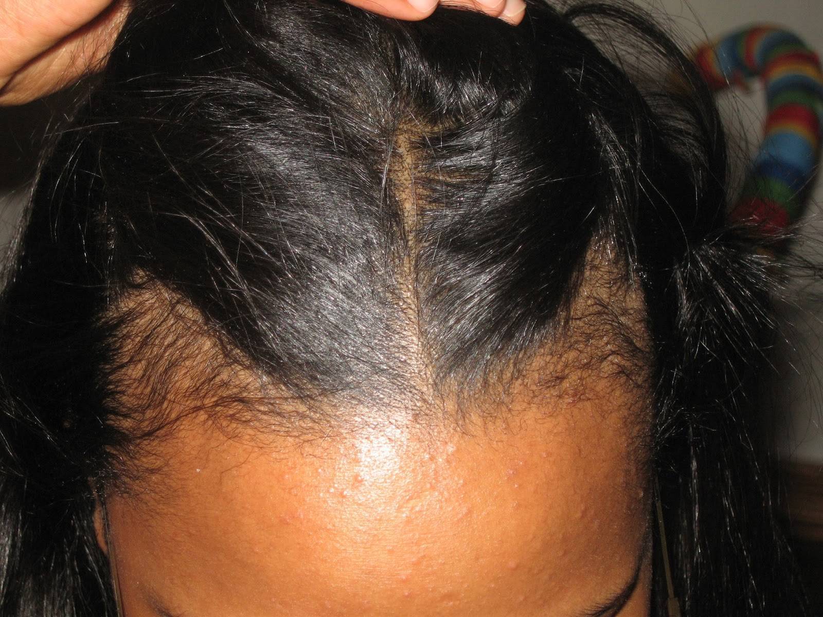 Выпадение волос после родов - причины и лечение