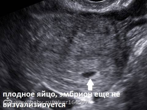 Эмбрион не визуализируется на 6 неделе - беременная
