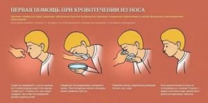 Причины и лечение кровотечения из носа у детей, первая помощь