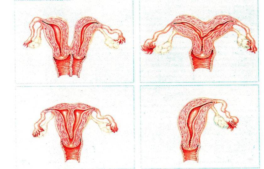 Седловидная матка - причины развития, влияние на беременность