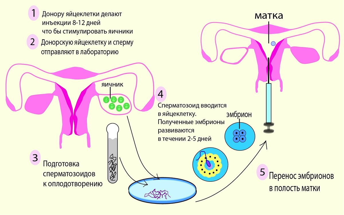 Эко в естественном цикле: что это такое, схема протокола, шансы на успех в ец после 40 лет, перенос (подсадка) эмбриона, криоперенос
