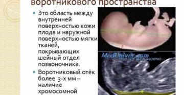 Норма твп плода на 12-13 неделе беременности