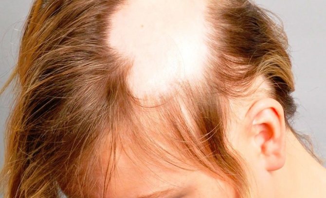 Очаговая алопеция у детей что это за профиль заболевание | обзор лучших средств от выпадения волос