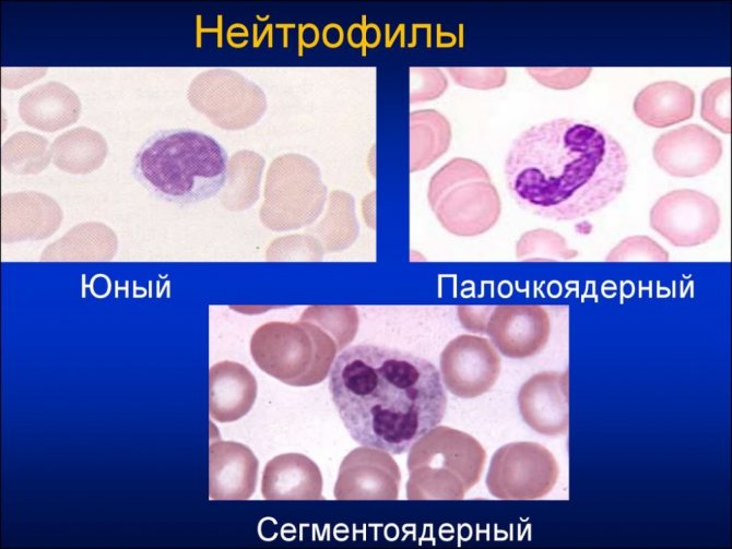 Понижены нейтрофилы в крови у ребенка: мало нейтрофилов, низкий уровень