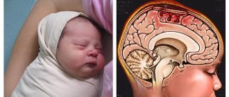 Особенности псевдокисты головного мозга у новорожденного