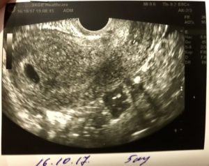 Не определяется эмбрион на 6 неделе беременности - вопрос гинекологу - 03 онлайн