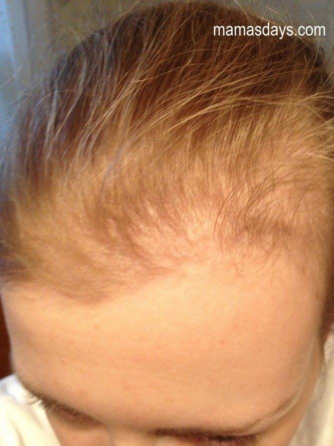 Выпадение волос после родов: причины, методы лечения, народные средства