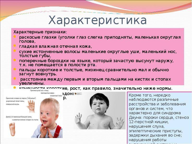 Синдром дауна: что это такое, почему рождаются дети с синдромом дауна, причины / mama66.ru
