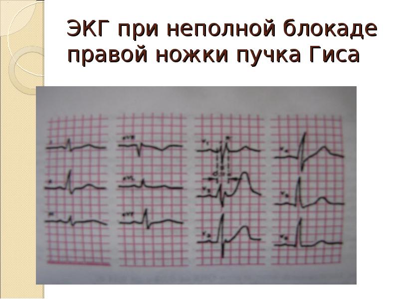 Неполная блокада пнпг. ЭКГ неполная блокада правой н.п.Гиса. Неполная блокада ПНПГ на ЭКГ. Неполная блокада правой ножки п.Гиса на ЭКГ. ЭКГ при неполной блокаде правой ножки пучка Гиса.