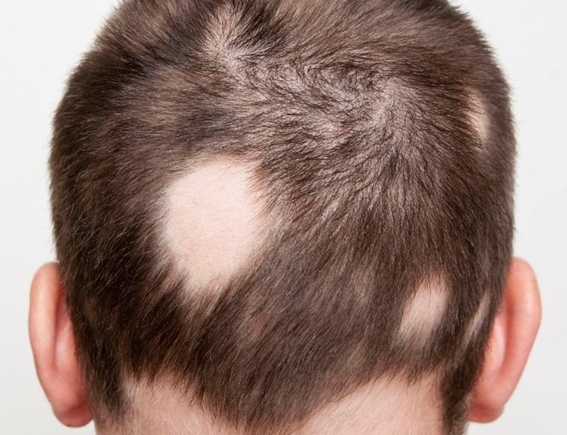 Алопеция (облысение, выпадение волос). причины, виды, лечение и профилактика патологии