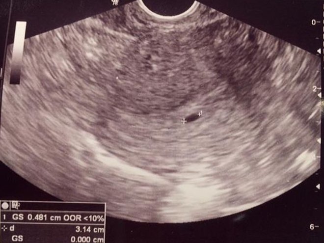 4 неделя беременности по эмбриональному сроку