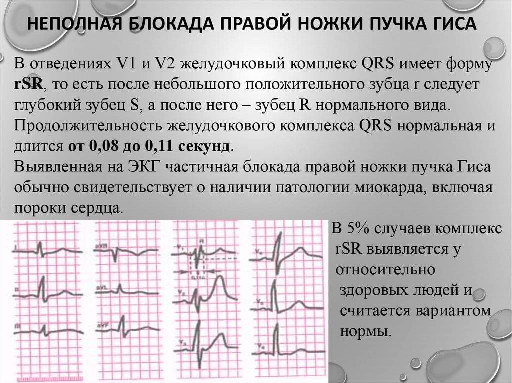 Неполная блокада правой ножки пучка гиса картинки