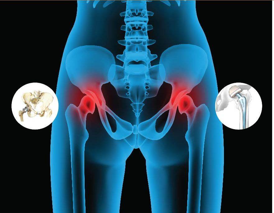 Признаки и методы лечения артрита тазобедренного сустава у детей