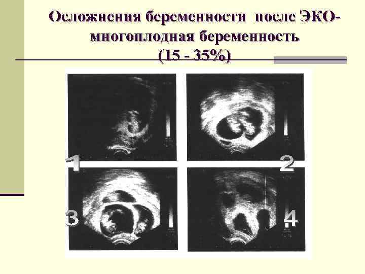 Редукция эмбриона