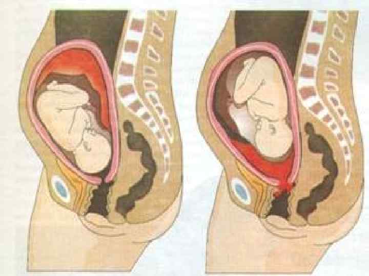 Предлежание плаценты: «безвыходная» беременность - наблюдение беременности.  здоровье