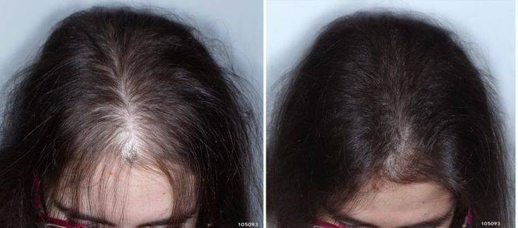 Волосы с луковицей выпадают: как это выглядит и почему происходит? вырастают ли после выпадения? что делать? отвечаем на вопросы | moninomama.ru