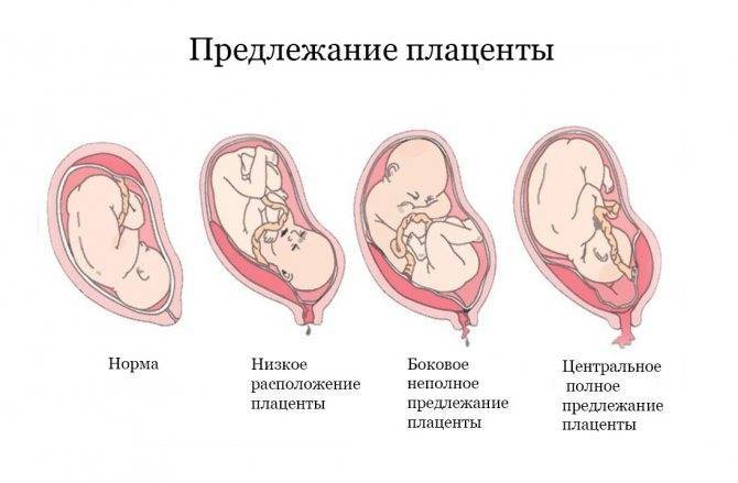 Плацента по передней стенке и шевеления плода: особенности беременности, ощущение женщины и мнения гинекологов