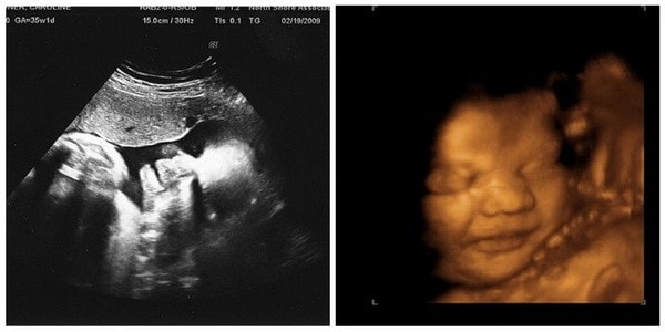 34 неделя беременности: что происходит с малышом и мамой, фото, развитие плода