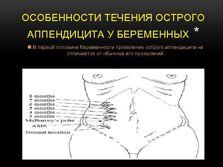 Где расположен аппендицит у человека схема расположения