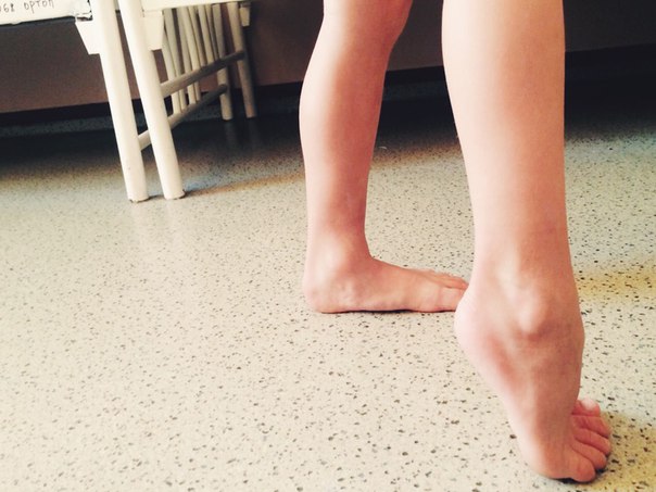 Ребенок ходит на носочках: причины, почему ребенок ходит на цыпочках, что делать в 1, 1, 5, 2, 3, 4 и 5 лет, комаровский