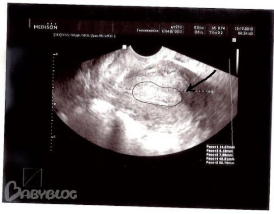 Киста яичника на узи (фото): могут ли ее перепутать с беременностью?