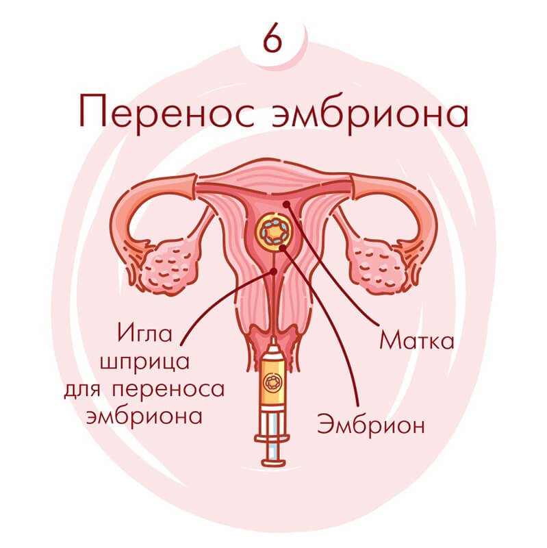 Перенос эмбрионов при эко: рекомендации до и после процедуры