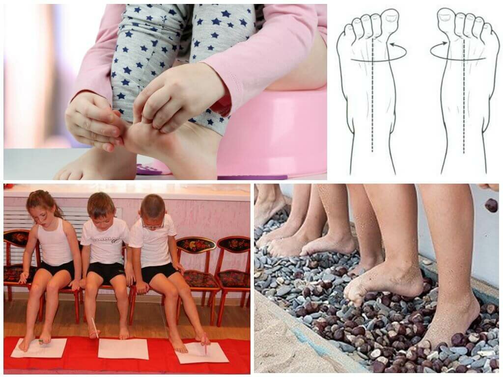 Профилактика плоскостопия у детей дошкольного возраста: гимнастика и упражнения, рекомендации для детей 2-3 лет
