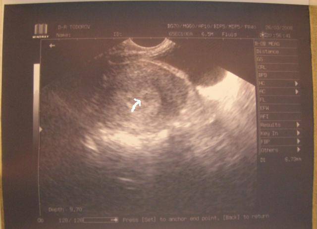 Узи на 2-3 неделе беременности (18 фото): как выглядит ребенок, 2 неделя от зачатия, что означает срок меньше акушерского