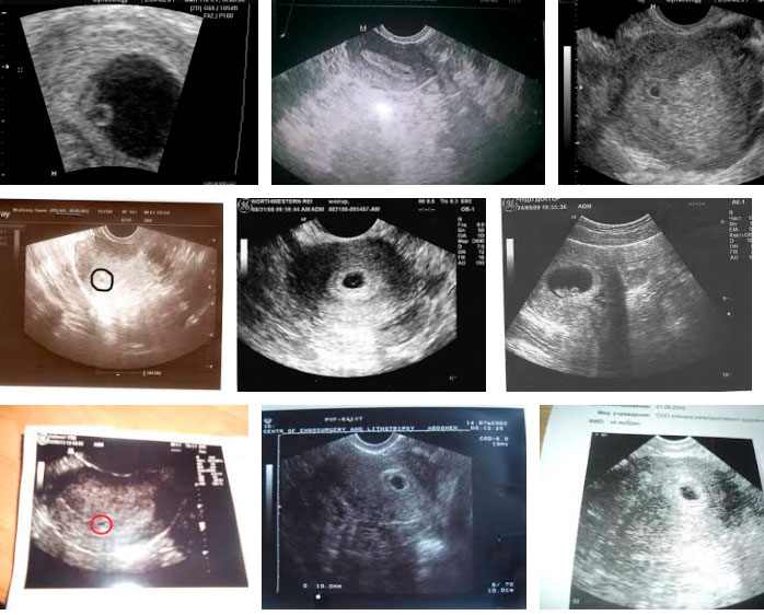 Узи 1 (первая) неделя беременности фото