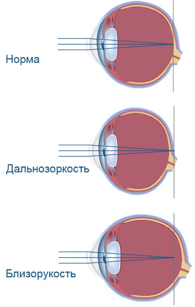 Основные степени гиперметропии глаза