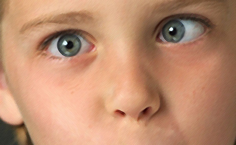 Амблиопия у детей: что это такое, признаки и лечение при высокой степени, как лечить глаза в домашних условиях