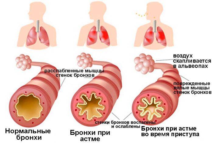 Лечение аллергического бронхита у детей | pnevmonya.ru