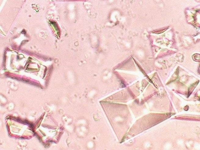 Аморфные кристаллы в моче у ребенка — почки