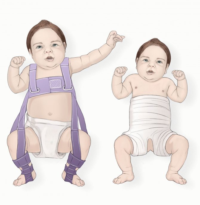 Дисплазия тазобедренных суставов у грудничка, новорожденного, у детей до года – признаки, лечение, массаж, гимнастика при дисплазии