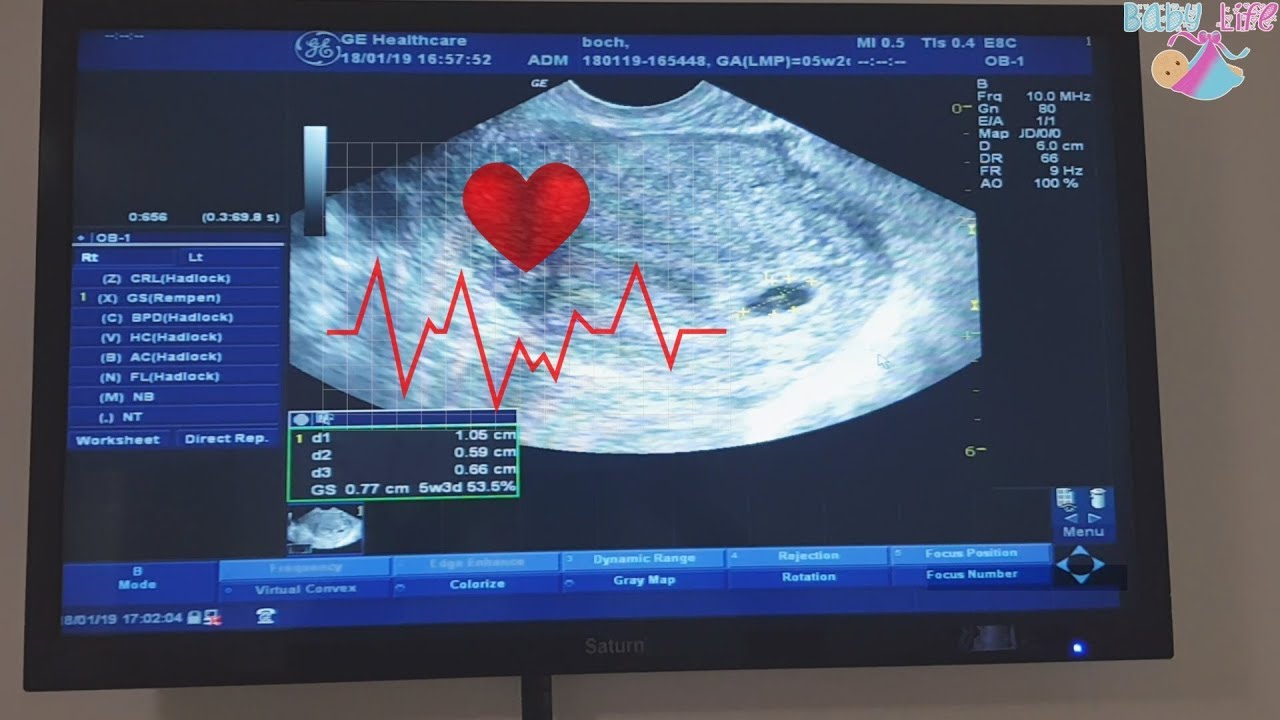 При каком хгч слышно сердцебиение и видно эмбрион