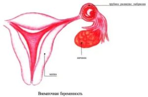 Спайки и беременность: как влияют, симптомы наличия в малом тазу, могут ли болеть, тянуть в матке, яичниках, кишечнике
