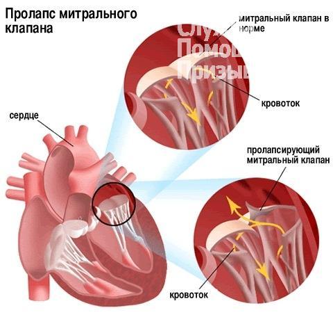 Пролабирование сердечных клапанов – норма или патология? Разбираемся с детским кардиологом
