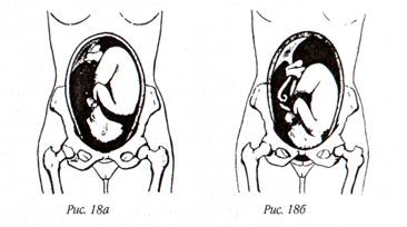 Предвестники родов  | гинекология.инфо