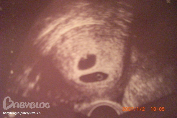 На каком сроке можно определить наличие двойни – когда на УЗИ видно многоплодную беременность?